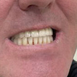 caz implantologie protetica dentara 12