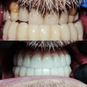 Pacient b&a 1