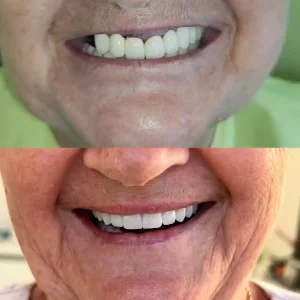 before and after implanturi dentare (1)