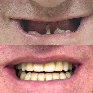 before and after implanturi dentare (2)
