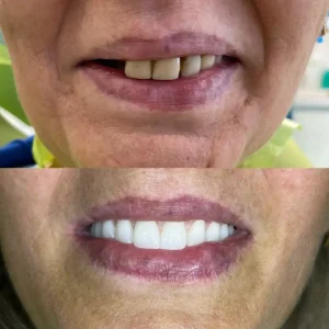 before and after implanturi dentare(1)